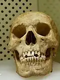 Pfeifenlöcher im Gebiss eines Schädels aus dem 18. Jh. Archäologisches Landesmuseum Brandenburg