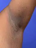 Acanthosis nigricans, klinisch