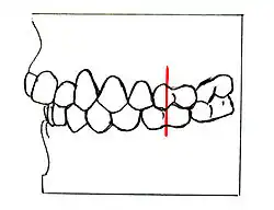 Angle-Klasse I