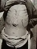 Von Schistosomiase Betroffener (China)