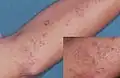 Lichen planus atrophicus