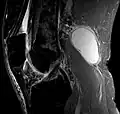 Baker-Zyste in der Kernspintomographie sagittal. Verbindung zum Gelenk nicht mit abgebildet.