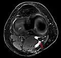 Baker-Zyste MRT axial mit Durchtrittsstelle (Pfeil) zwischen M. semimembranosus und M. gastrocnemius Caput mediale.