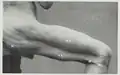 Oberflächenanatomie der Oberschenkelaußenseite. Gluteus maximus durch x gekennzeichnet.
