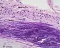 Mit Hämatoxylin-Eosin gefärbtes Präparat einer arteriellen Wand mit kalzifiziertem atherosklerotischem Plaque