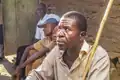Von Onchozerkose Betroffener in Kamerun