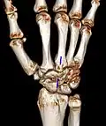 Carpal boss in der Computertomographie: VR-3D-Rekonstruktion. Pseudarthrotische Verbindung der Knochenvorsprünge am Os metacarpale 3 und am Os trapezoideum.