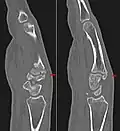Carpal boss in der Computertomographie: 2 nebeneinander liegende Schichten einer sagittalen MPR.