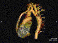 Aortenisthmusstenose – Rekonstruktion 3D