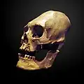 Deformierter und trepanierter Schädel