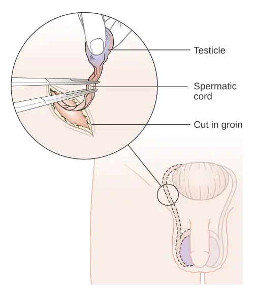 Diagram showing how the testicle is removed (orchidectomy) CRUK 141