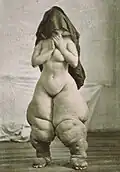 Klinische Aufnahme für eine Fachzeitschrift: anonymisiert fotografierte Betroffene mit Elefantiasis (1878)