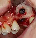 Externer Sinuslift mit Implantation Regio 26 – Eingedrehtes Implantat mit Einheilschraube
