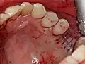 Externer Sinuslift mit Implantation Regio 26 – Vernähte Gingiva nach Abschluss