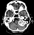 Großes Felsenbeinmeningeom in der Computertomographie