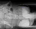 Pneumoperitoneum auf einer Röntgenaufnahme bei einem auf der linken Seite liegenden Patienten. Die freie „Luft“ in der Bauchhöhle (grüne Pfeile) sammelt sich oberhalb der Leber (rote Pfeile auf Leberrand). Bei freier Flüssigkeit in der Bauchhöhle bildet sich ein Luft-Flüssigkeits-Spiegel (blaue Pfeile).