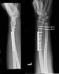 Gleiche Fraktur nach osteosynthetischer Versorgung. Das DRUG ist mit zwei kräftigen Kirschnerdrähten fixiert (Pfeile)