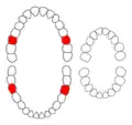 Zahnschema; Sechsjahrmolaren (rot), rechts das Milchgebiss