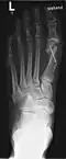 Hammerzehen nach der operativen Korrektur; deutlich sind die verkürzten dritten Glieder der drei inneren Zehen erkennbar (Operation nach Hohmann). Bei dieser OP wurde auch der Hallux valgus korrigiert.