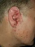 Staphylokokkeninfektion der Ohrmuschel
