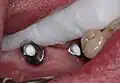 Eingeschraubte Abutments auf Implantaten kurz vor Einsetzen einer Implantatbrücke