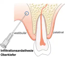 Penetration der Kanüle einer Betäubungsspritze für die Lokalanästhesie in der Zahnmedizin