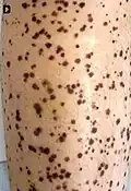 Bein eines 37-Jährigen mit LEOPARD-Syndrom