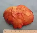 Das resezierte Lipom (8 cm&nbsp;×&nbsp;6 cm&nbsp;×&nbsp;3 cm)[15]