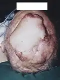 Rezidiv sechs Wochen nach der Tumorresektion. Um den transplantierten Hautlappen sind mehrere Satellitenmetastasen erkennbar.