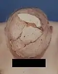 Revision mit tiefgreifender Tumorresektion und Verschluss der Operationswunde mit einem myokutanen Hautlappen des Musculus latissimus dorsi.