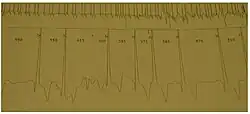 Ein 24-Stunden-EKG wird häufig vor und nach einer Enzymersatztherapie durchgeführt, wenn der Patient über Herzrhythmusstörungen oder Herzklopfen berichtet.
