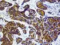 Knochen- und Weichteilmetastase eines Prostatakarzinoms mit immunhistochemischem Nachweis einer PSA-Expression (braun)