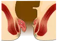 Hämorrhoiden zweiten Grades