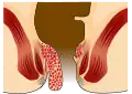 Hämorrhoiden dritten Grades