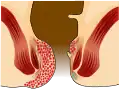 Hämorrhoiden vierten Grades