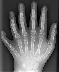 Eine moderne Aufnahme einer linken Hand mit 6&nbsp;Fingern (Polydaktylie)