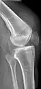 Kompletter Riss mit tief stehender Patella