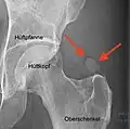Tendinosis calcarea der Hüfte