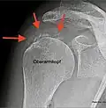 Tendinosis calcarea im Resorptionsstadium