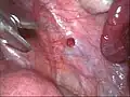 Roter Endometrioseherd