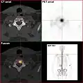 Natriumfluorid-PET/CT desselben Patienten: Die osteolytische Knochenmetastase in der Halswirbelsäule zeigt einen extremen Uptake und ist klar erkennbar. Die beiden weiteren Knochenmetastasen in der Lendenwirbelsäule stellen sich in der PET/CT-Aufnahme ebenfalls sehr gut dar.