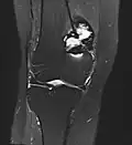 MRT-Bild (koronare PDfs-Sequenz) eines histologisch gesicherten Riesenzelltumors des Oberschenkelknochens