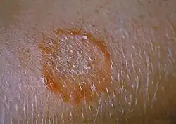 Tinea corporis am Arm