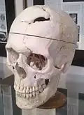 Schädel von Gage, ausgestellt im Warren Anatomical Museum der Harvard Medical School