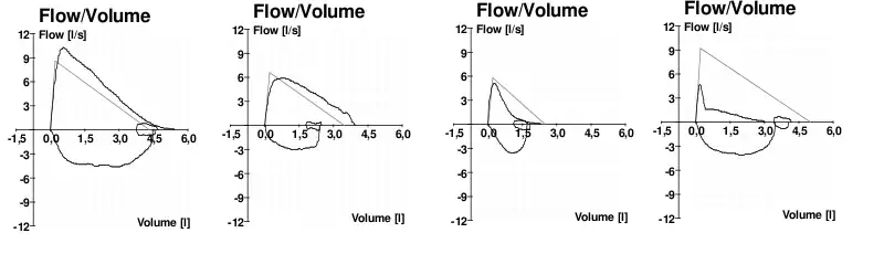 Typische Fluss-Volumen-Diagramme bei (v. l. n. r.) normaler Atmung, fehlender Mitarbeit des Patienten, Asthma, und COPD