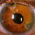 Partielle Irisprothese