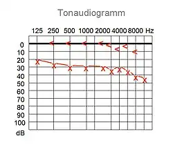 Tonaudiogramm, Schallleitungsstörung