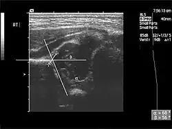 Ultraschall Ib Hüfte