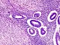 Adenomyosis uteri im mikroskopischen Bild