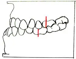 Angle-Klasse III